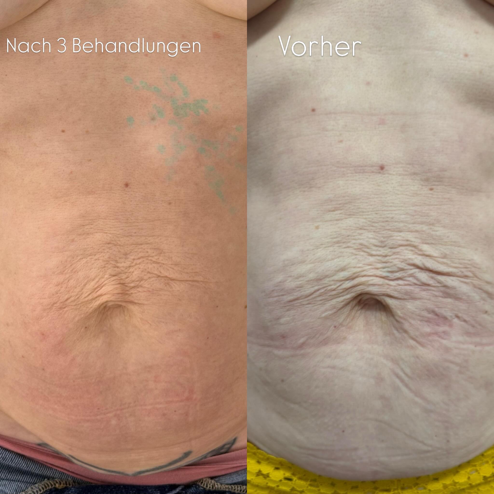 ✨ Hautstraffung ist nicht glei… ✨ Hautstraffung ist nicht glei…
